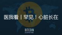医我看丨罕见！心脏长在右胸膛！珠海成功开展首例“右位心”房颤射频消融术