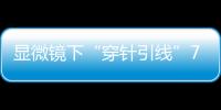 显微镜下“穿针引线”7小时！金湾这家医院成功帮患者保住断肢